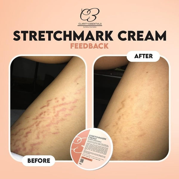 Clarity Essential Stretchmark Cream