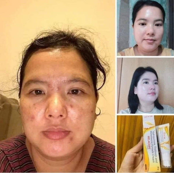 Melacare Cream 25g