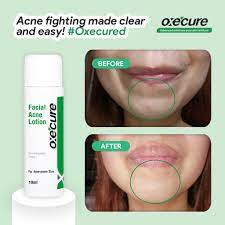 Oxecure Facial Acne Lotion