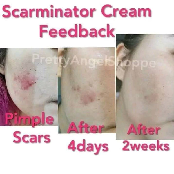 Scarminator Cream (Scar Remover)